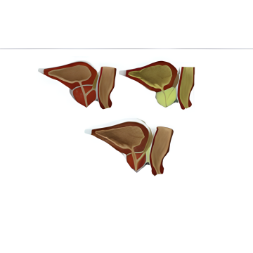 Modèle pathologique de la prostate (conditions ou maladies pathologiques)