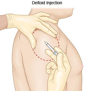 Intramuscular Injection