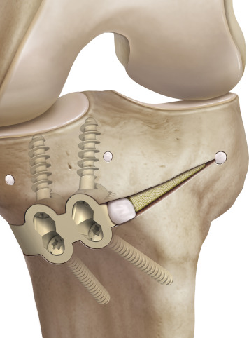 PEEK BONES APPLICATION-NEWS