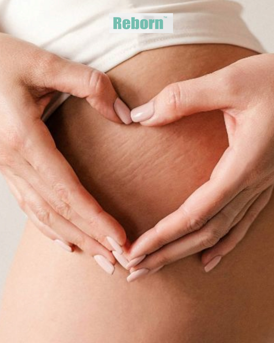 Reborn PLLA for Postpartum Stretch Mark (Stri