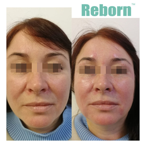 Mesotherapy Injection Hydrogel Filler