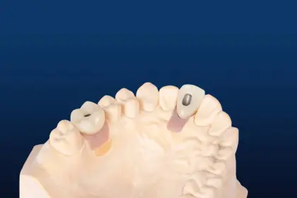 Anatomical Implant Restoration Crown