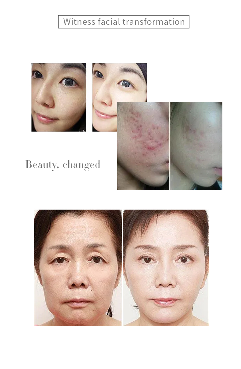 Hyaluronic acid needleless injector