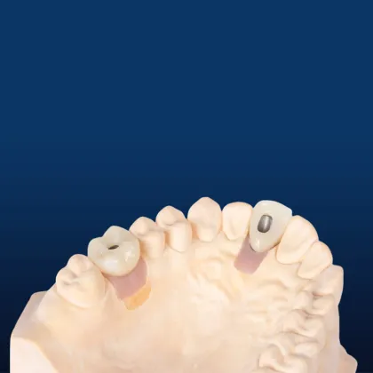 Customized Dental Implant Porcelain
