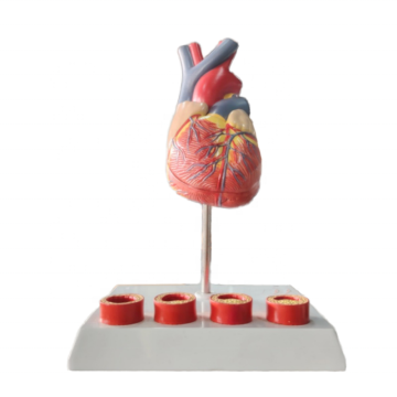Darhmmy Medical Science Heart Model avec quatre étapes de la pathologie vasculaire