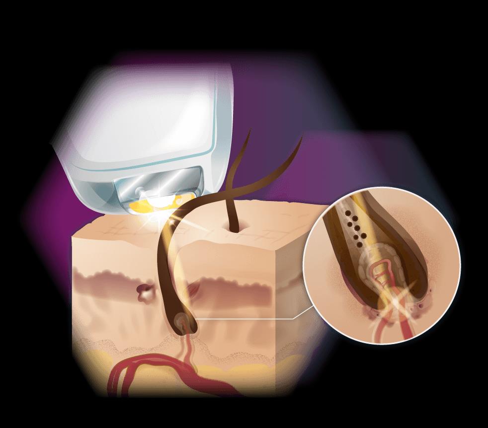 laser hair removal home kit