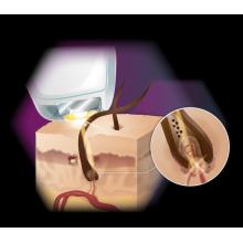 Portable depilator diode laser 755nm 808nm 1064nm epilator laser hair removal beauty machine