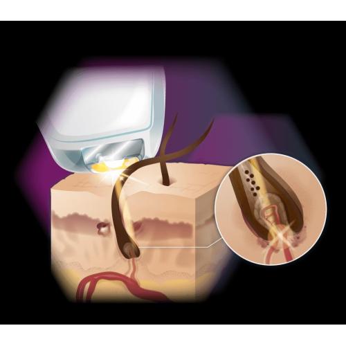 Портативный дефилатор диодный лазер 755 нм 808 нм 1064 нм эпиляторный лазерный лазерный удаление волос.