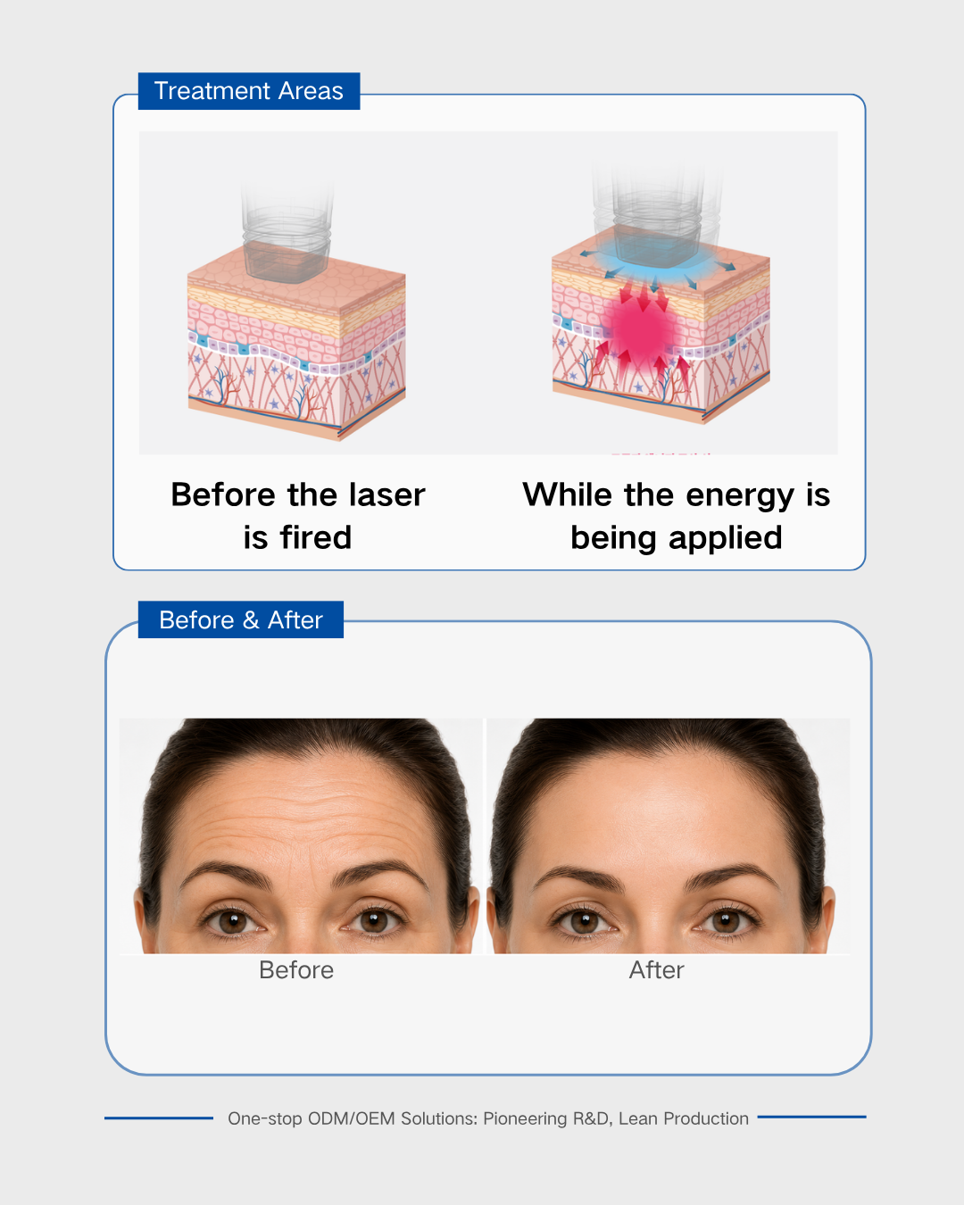 High-Intensity Focused Ultrasound for Skin Li