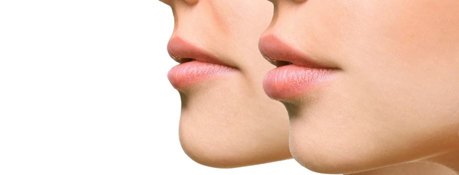 dermal-filler-injections
