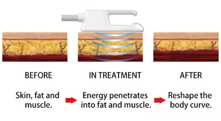 Body Slimming Massage Device