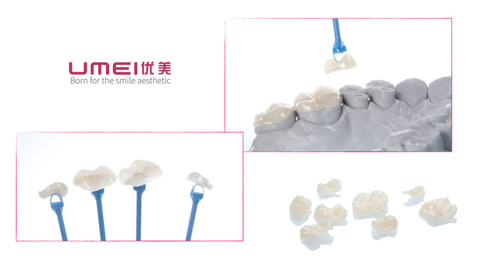 วีเนียร์บดเคี้ยว occlusal veneers
