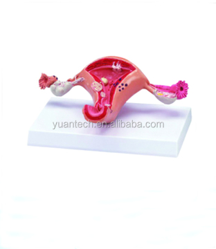 Diseased Uterus Model - YA/P016