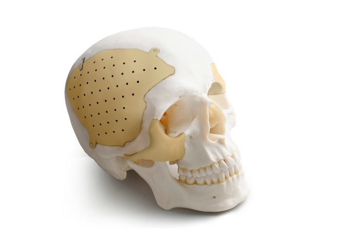 PEEK-BONE-NEWS