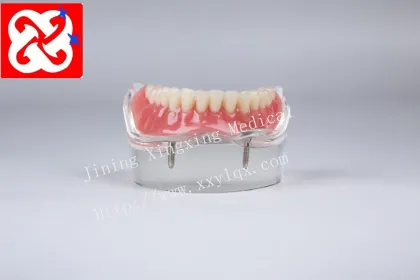Mandibular Overdenture Restoration with 2 Implants