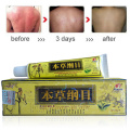 15g Psoriasis Cream For Dermatitis And Eczema Pruritus Psoriasis Ointment Herbal Creams