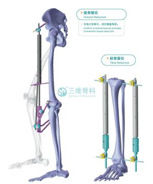 Minimally Invasive Reduction Frame for Fracture
