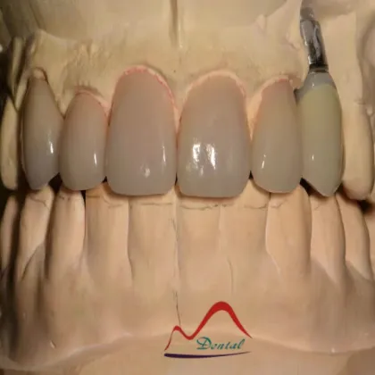 Dental All Ceramics CC Veneers