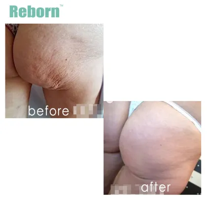 Medical Cosmetic Filler for Skin