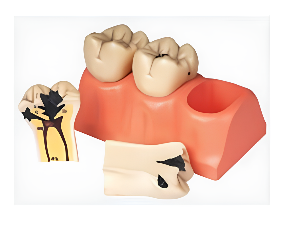 Modelo disecado de caries dental