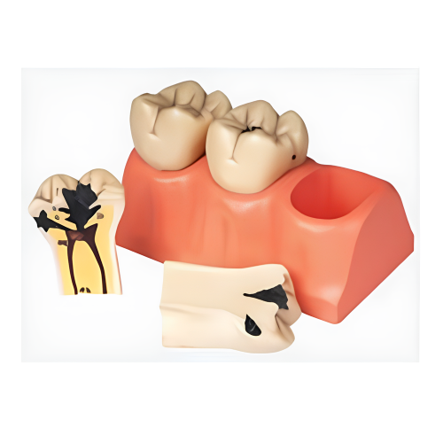 Рассеченная модель стоматологического кариеса