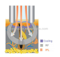 Superventas para depilación IPL Laser Machine