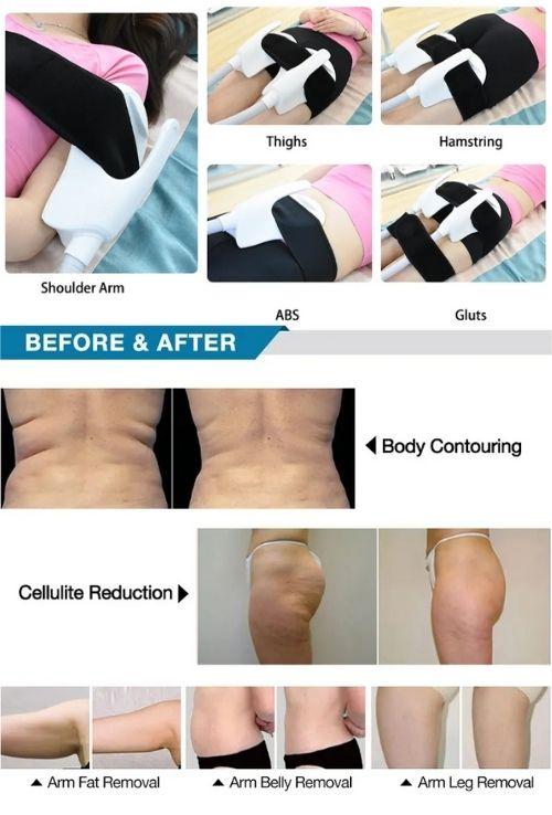 Treatment of Ems electric muscle stimulator