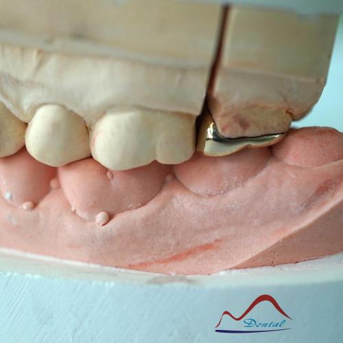 DENTAL Molar Gold Onlay