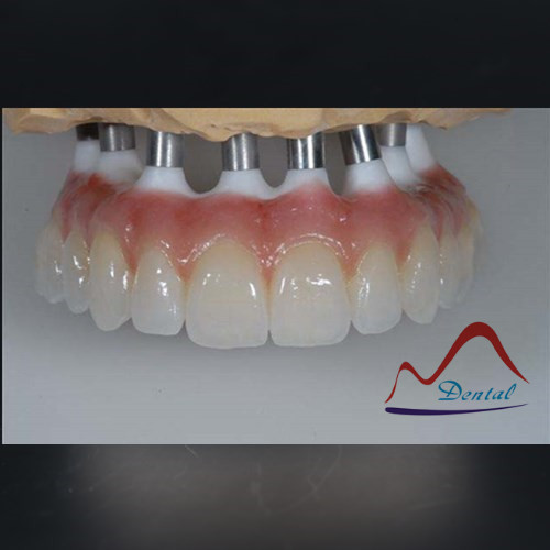 Dental Implant Hybrid Denture