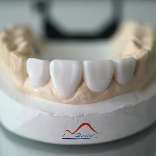 Aesthetic Dental Diagnostic Wax-up