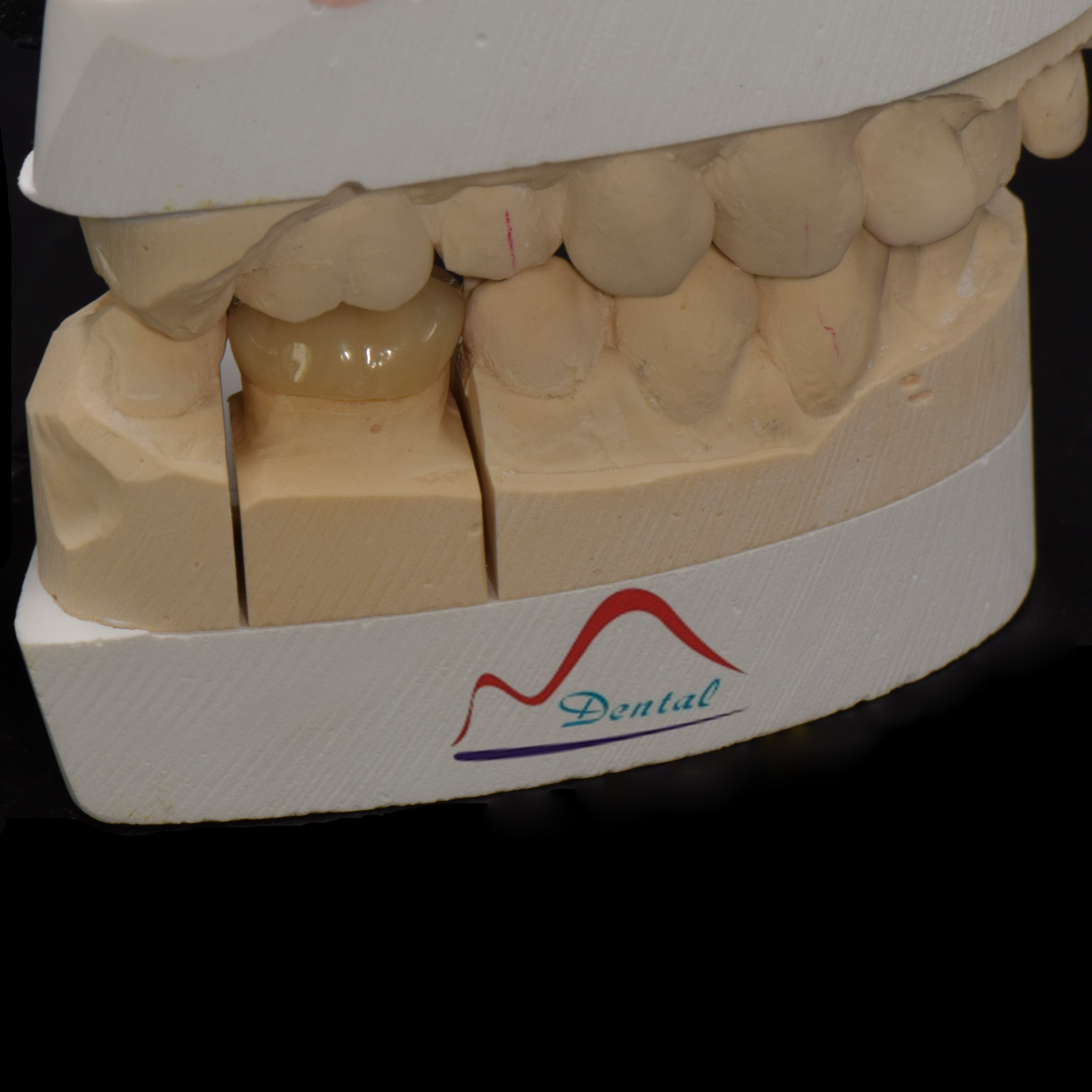 Posterior IPS e.max Press Prosthesis d