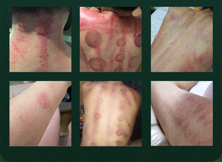 rf body slimming machine