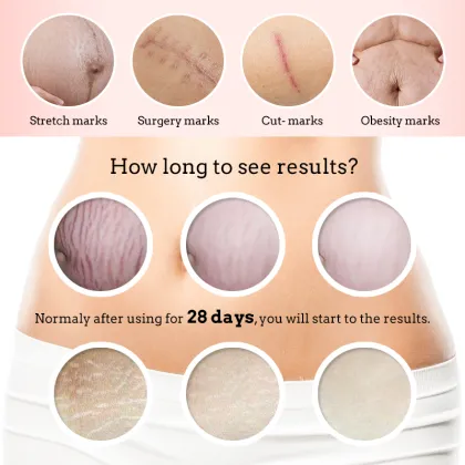 OMYLADY Stretch Marks & Scar Removal Cream