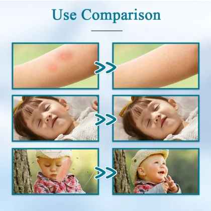 Private Label After Bites Soothing Gel 20ml - Mosquito Bite Itch Relief Pen