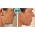 Anti Aging Reborn PLLA Dermal Filler Face Skincare