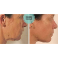 Anti Ogning Reborn PLLA Dermal Filler Face Skincare