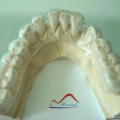 Dental Removable Bleaching Tray