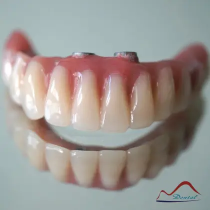 All-On-Four Dental Implant Restoration