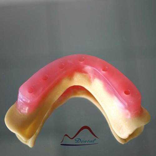 Implant Wax Rim Try In