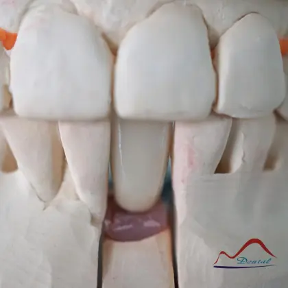 Mandibular Dental Implant Crown