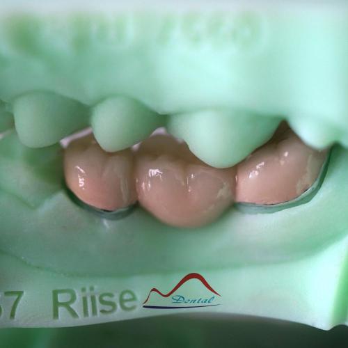 3D Printing Model PFM COCR Bridge