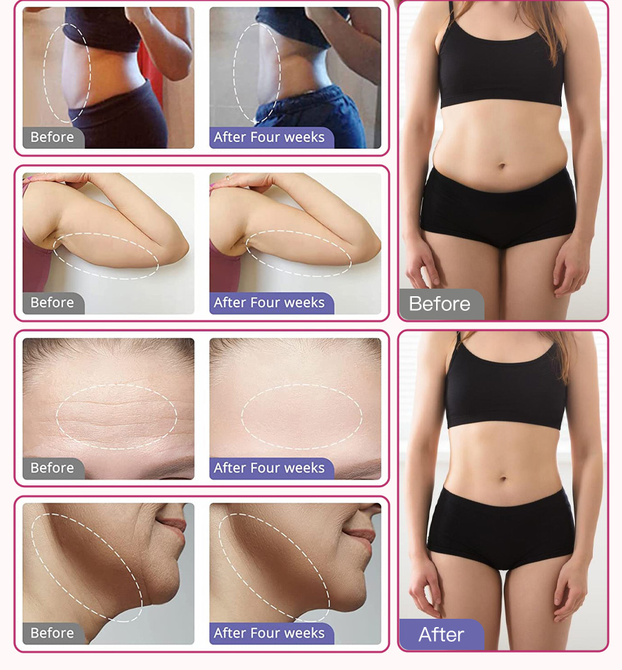 cavitation machine before and after