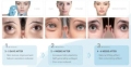 كوريا Amieyes Skinbooster Eyes Mesotherapy Ami عيون Skinbooster Lumi عيون Pdrn ereye العلاج تحت علاجات العين