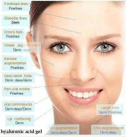 Singfiller sodium hyaluronate gel dermal filler