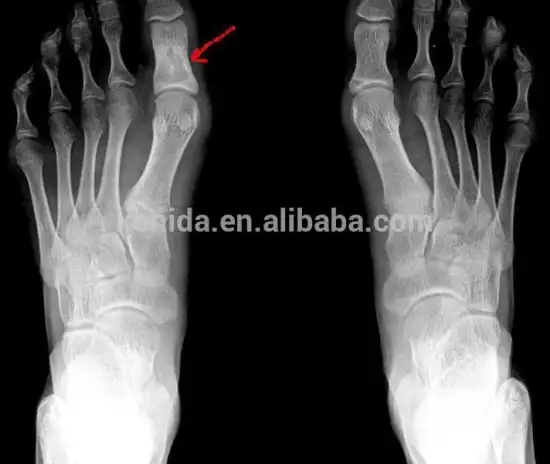 KND-F medicla xray film for Fuji Drypix 2000 high quality