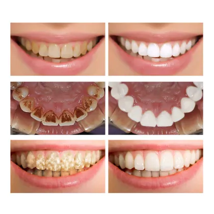 OMY LADY Teeth Whitening Essence: Best Selling Oral Hygiene Cleaning Serum in Europe