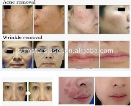 fractional co2 laser machine,co2 fractional laser,co2 laser device hot sale