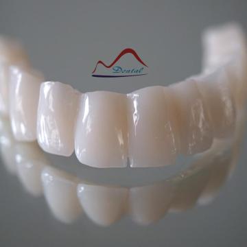 Maxillary Temporary Bridge With Wire