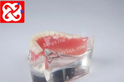 Mandibular Overdenture Restoration with 2 Implants
