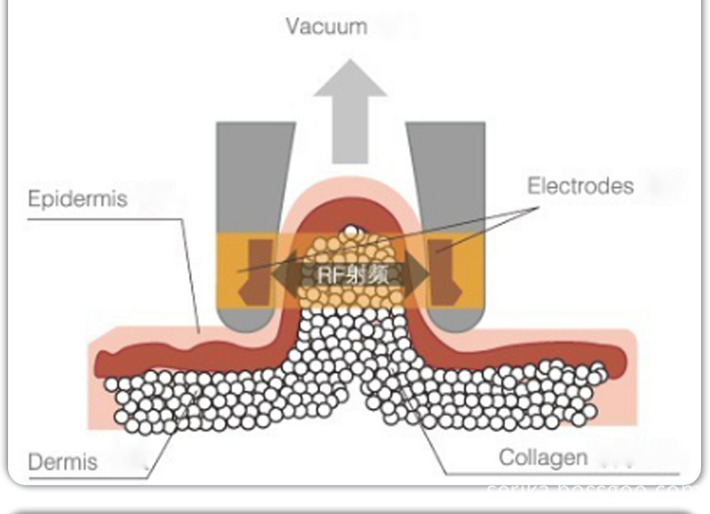 Cryolipolysis Cost